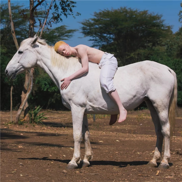 聚焦撒哈拉以南非洲白化病患者，她获得国际摄影大奖